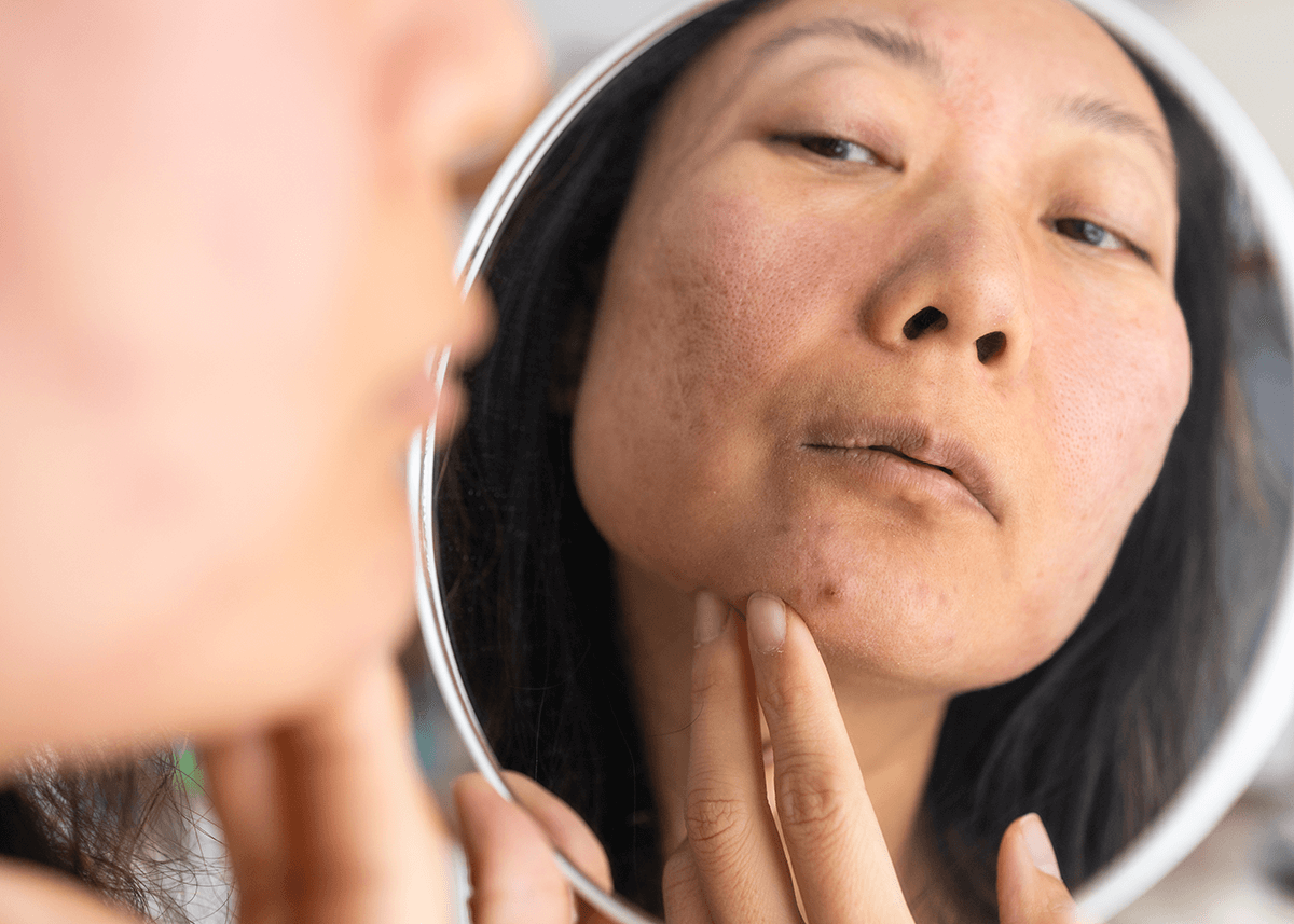 How to Cover a Pimple Featured Image